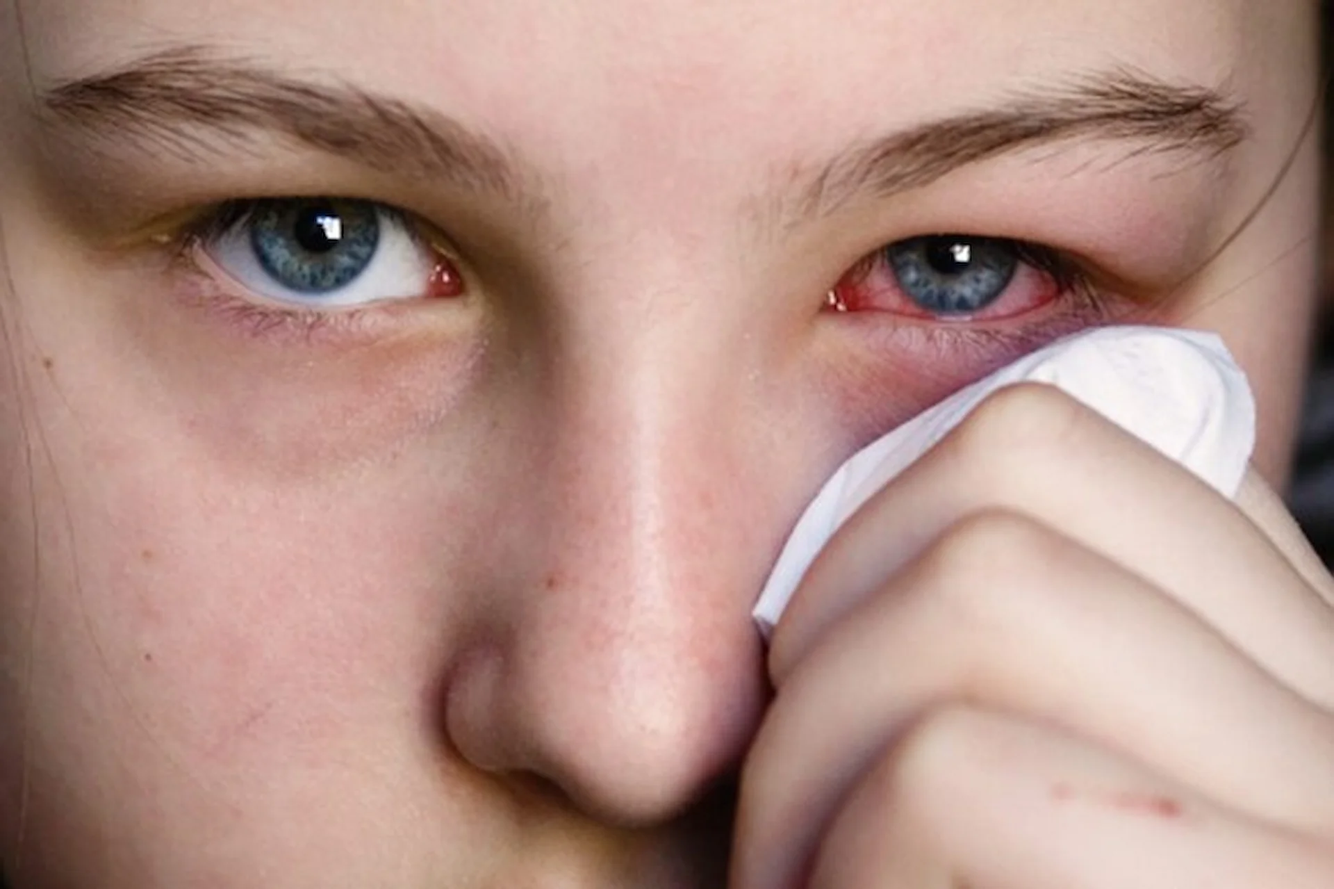 Pink eye being cleaned